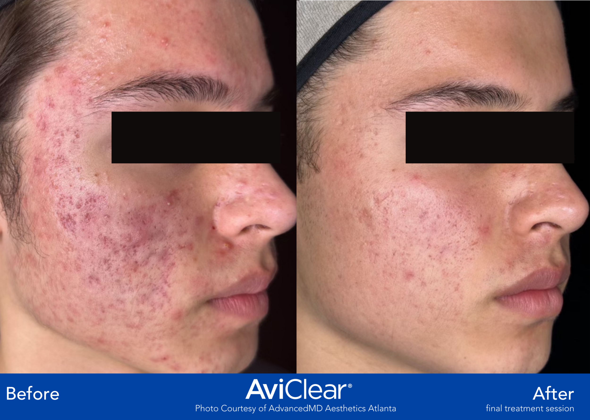 Before and After Image: AviClear - right-front-oblique