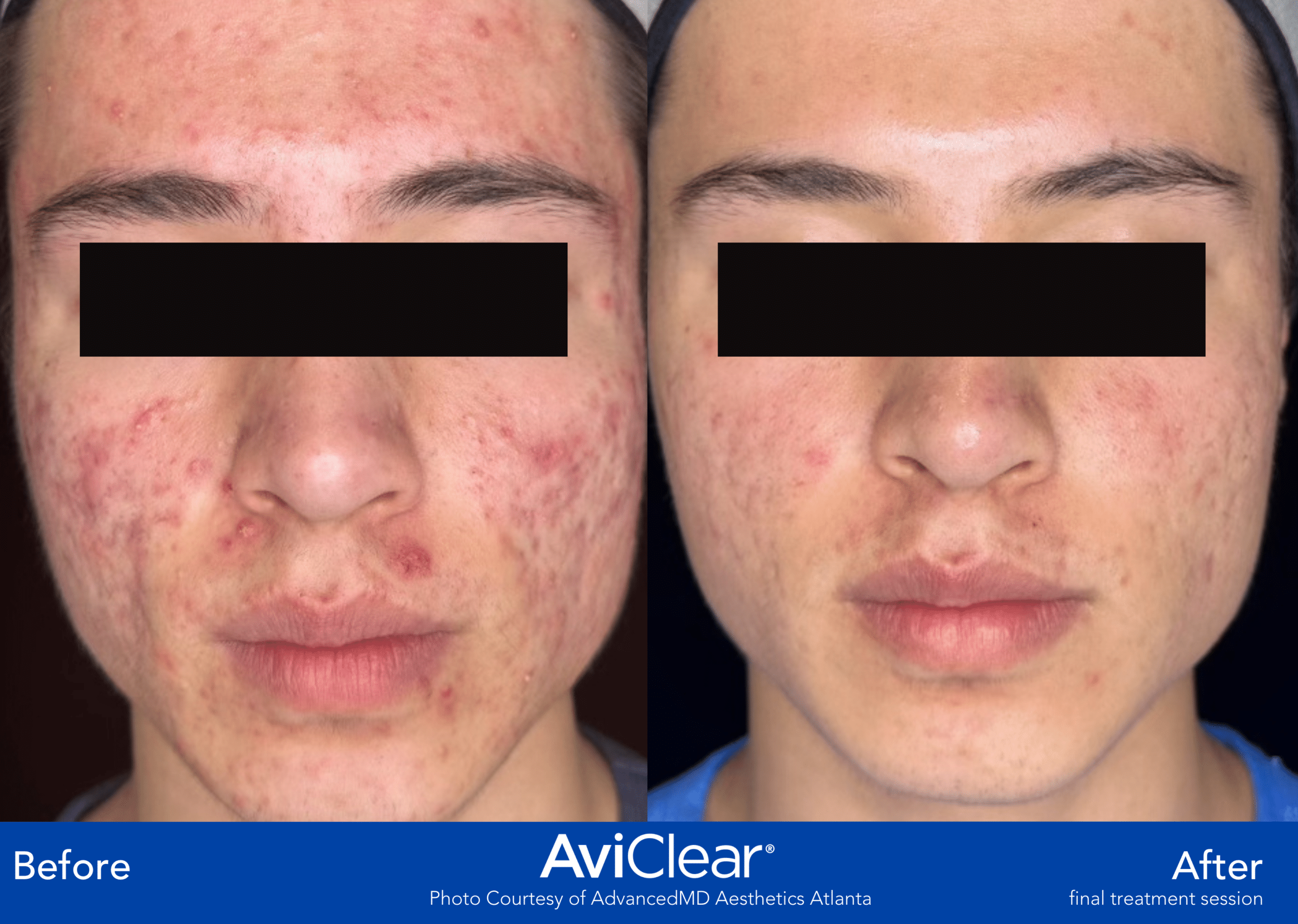Before and After Image: AviClear - front