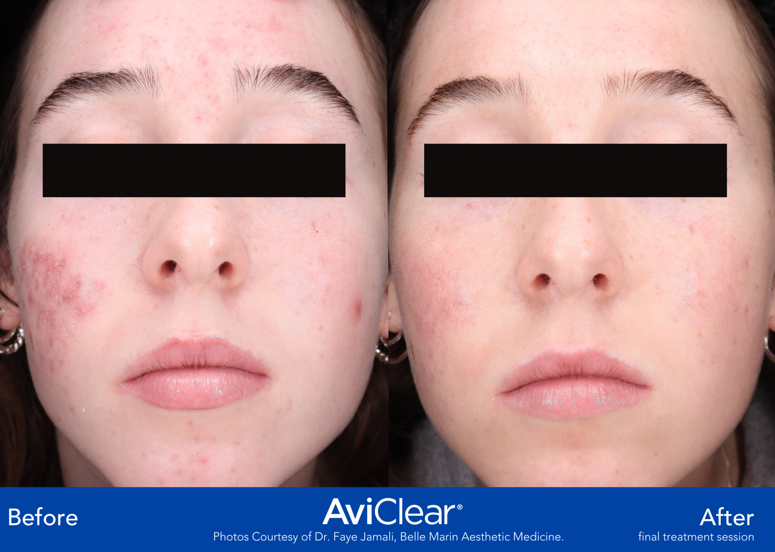 Before and After Image: AviClear - front
