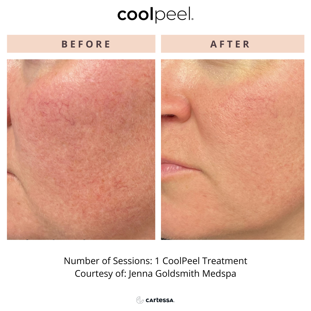 Before and After Image: CoolPeel - left-front-oblique