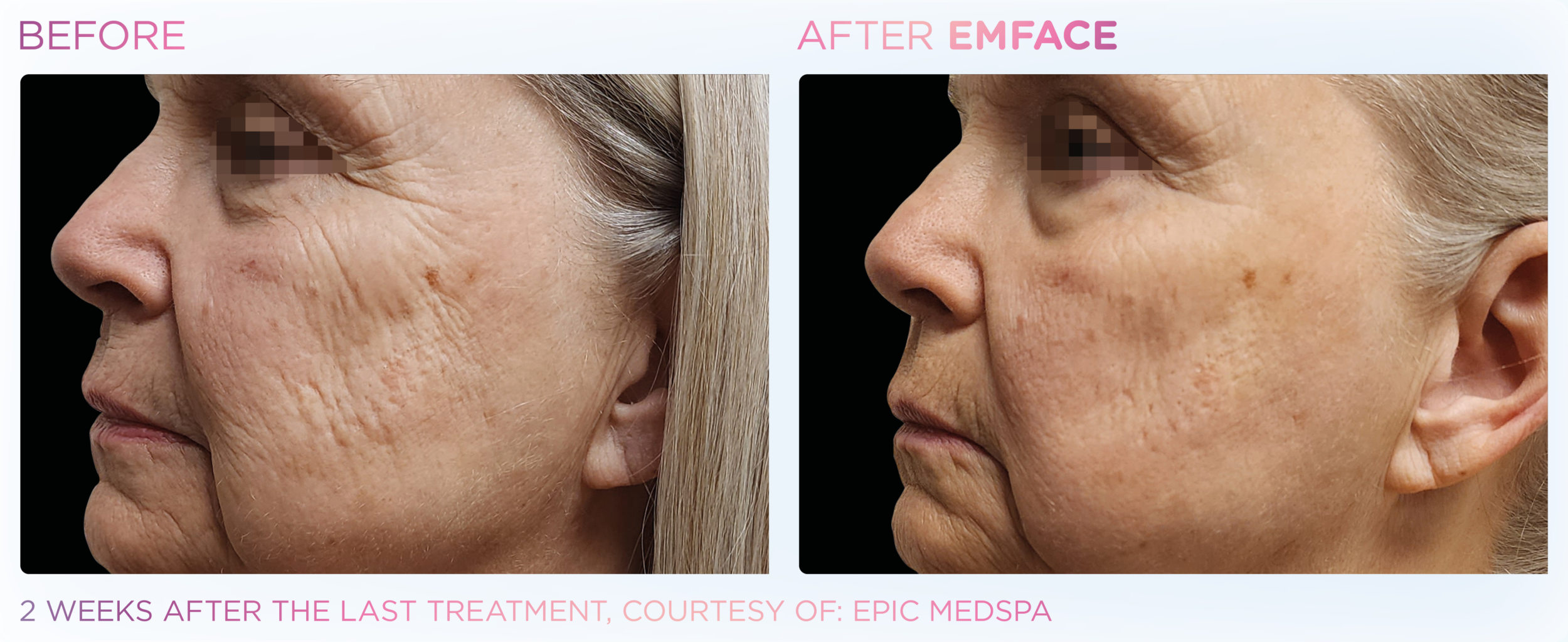 Before and After Image: Emface - left-side