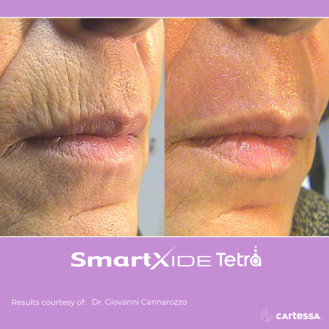 Before and After Image: Tetra CO2 - right-front-oblique