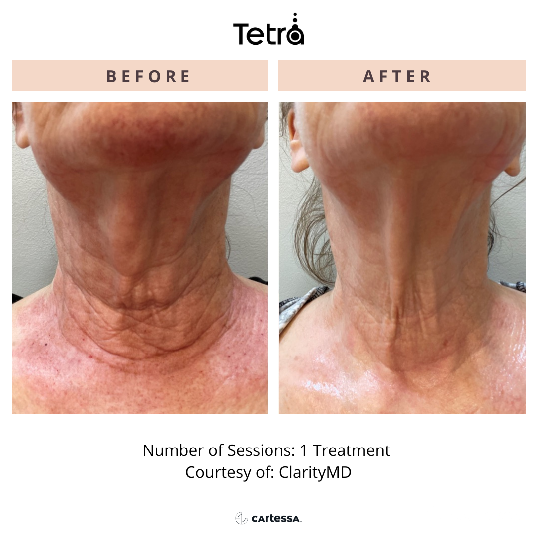 Before and After Image: Tetra CO2 - front