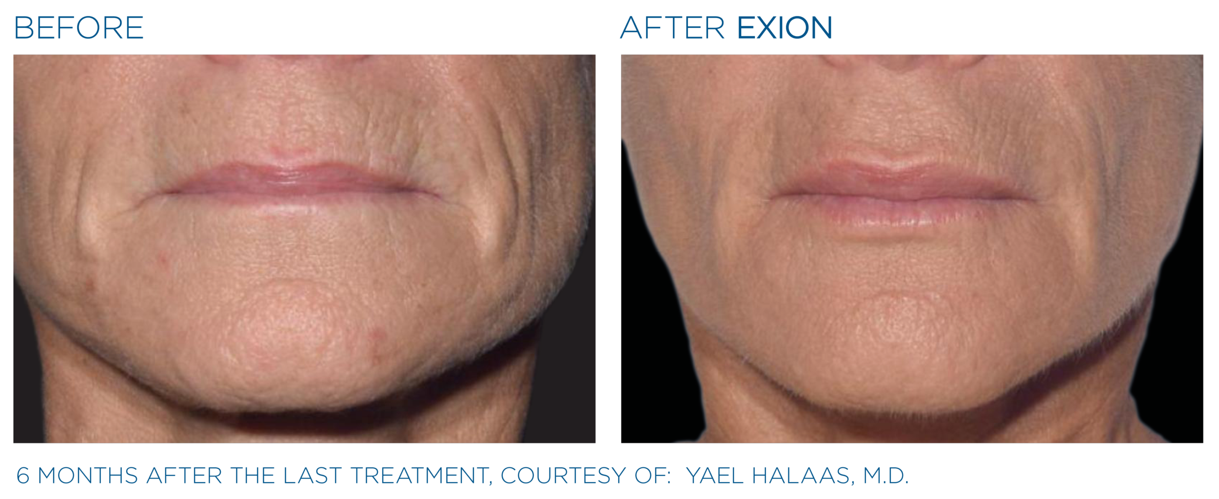 Before and After Image: Exion RF Microneedling - front