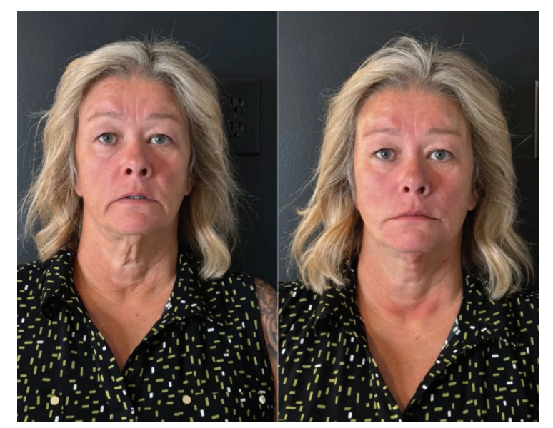 Before and After Image: PDO Thread Lift - front