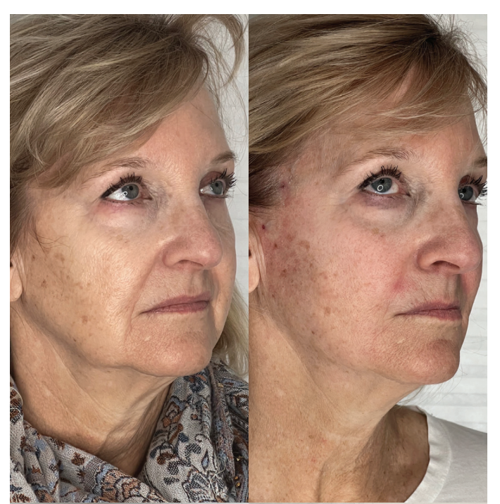 Before and After Image: PDO Thread Lift - right-front-oblique